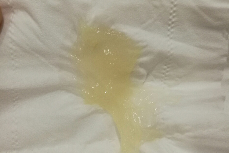 37周宫颈黏液栓果冻状图 37周宫颈黏液栓果冻状图