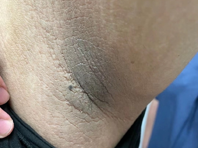 导致患者腋窝皮肤增厚,外观像天鹅绒样,同时病变皮肤伴有色素沉着,呈