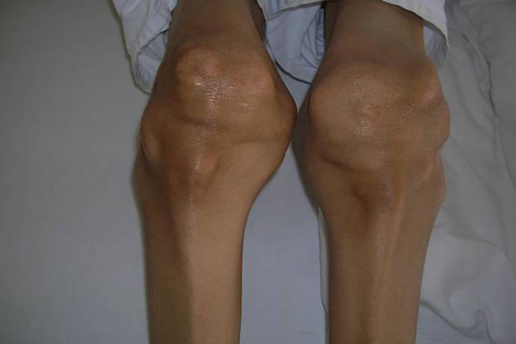 膝关节痛风石图 膝关节痛风石图