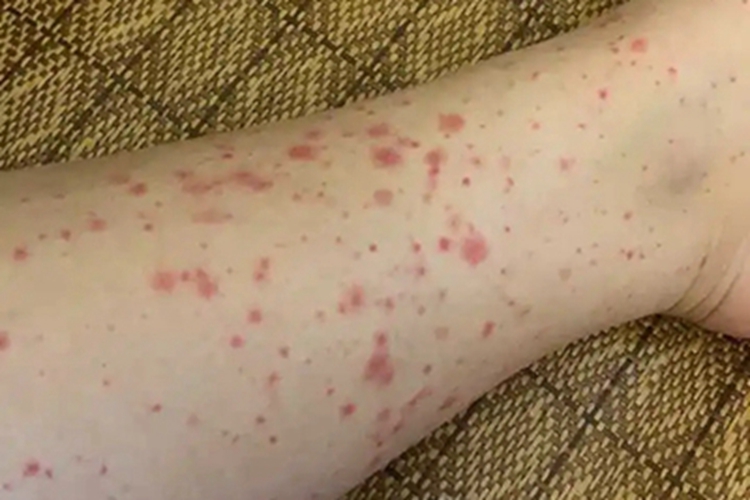 冷球蛋白血症性紫癜小腿红点图