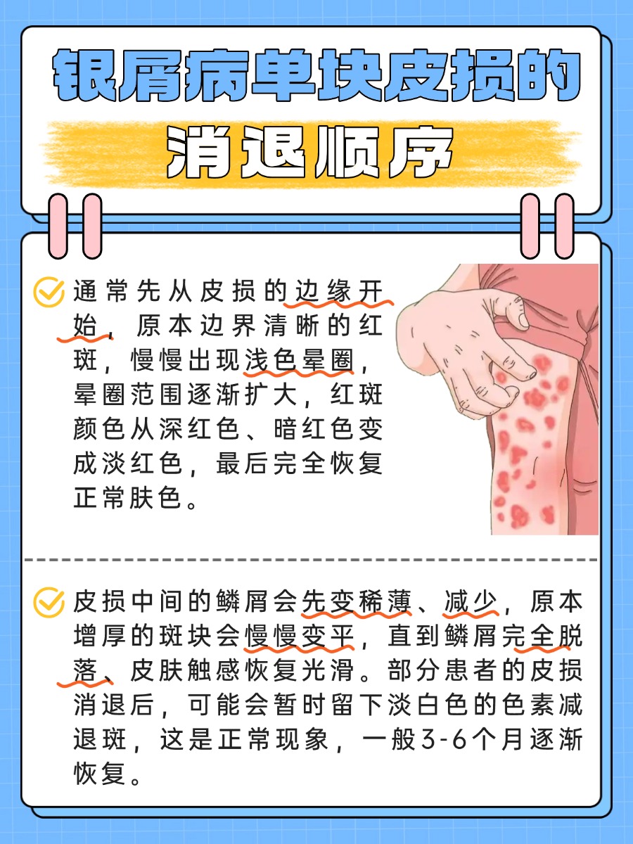 银屑病消退顺序，医生教你正确判断！