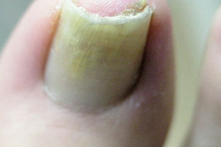 银屑病甲增厚图 银屑病甲增厚图