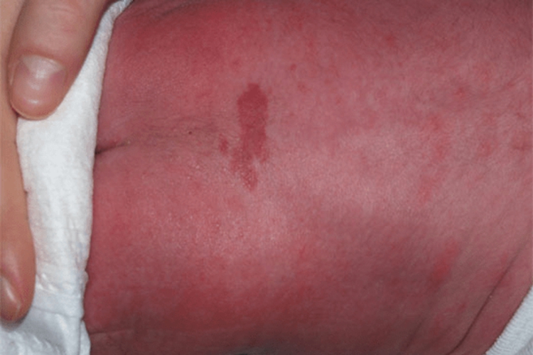 先天性皮毛窦凹陷图