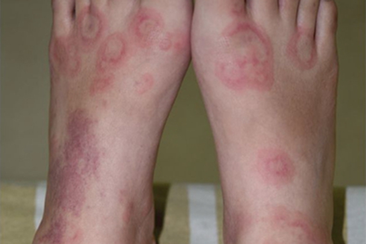荨麻疹脚背症状图
