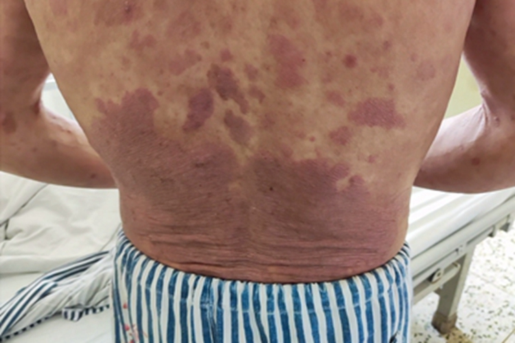 青年成人期特应性皮炎背部紫斑图