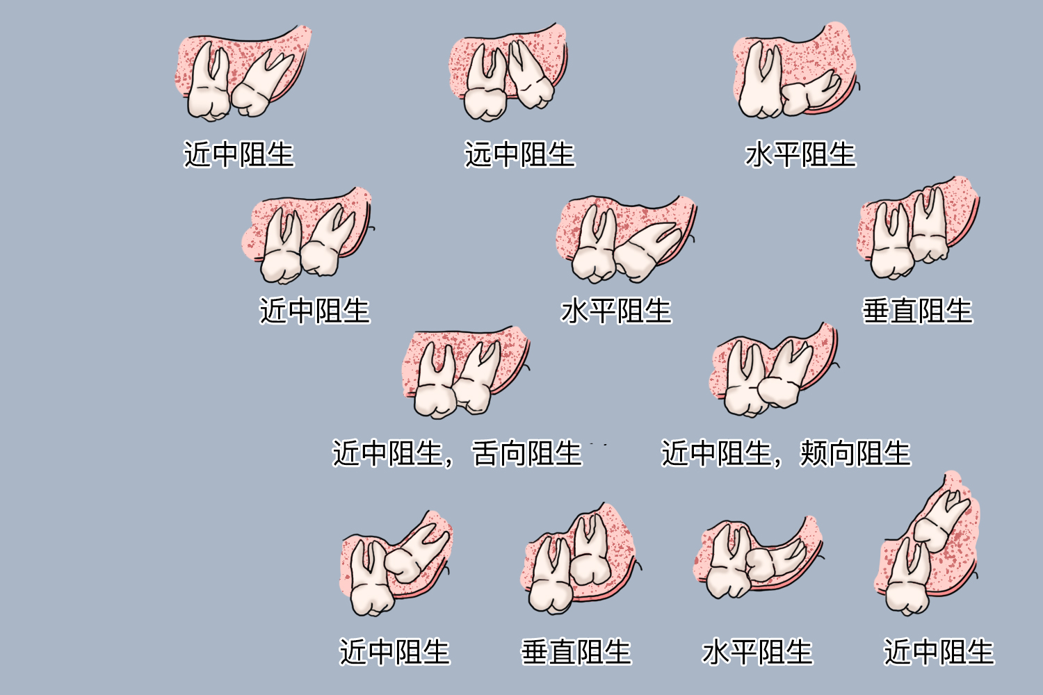 上颌智齿阻生分类图