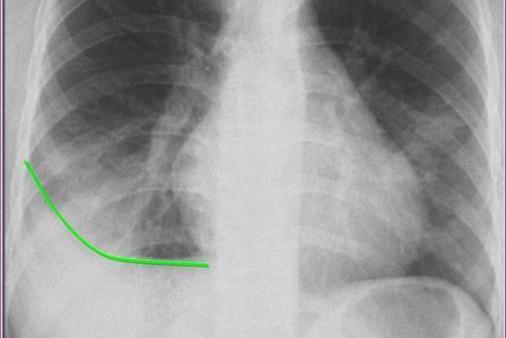 胸膜炎积液X线图