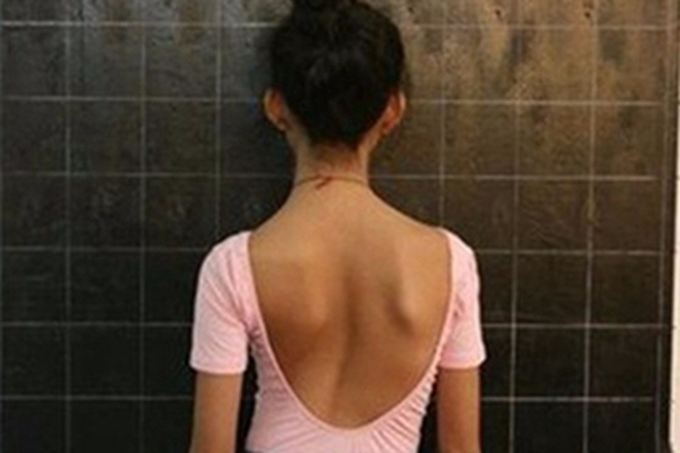 青少年型特发性脊柱侧弯变形图 青少年型特发性脊柱侧弯变形图