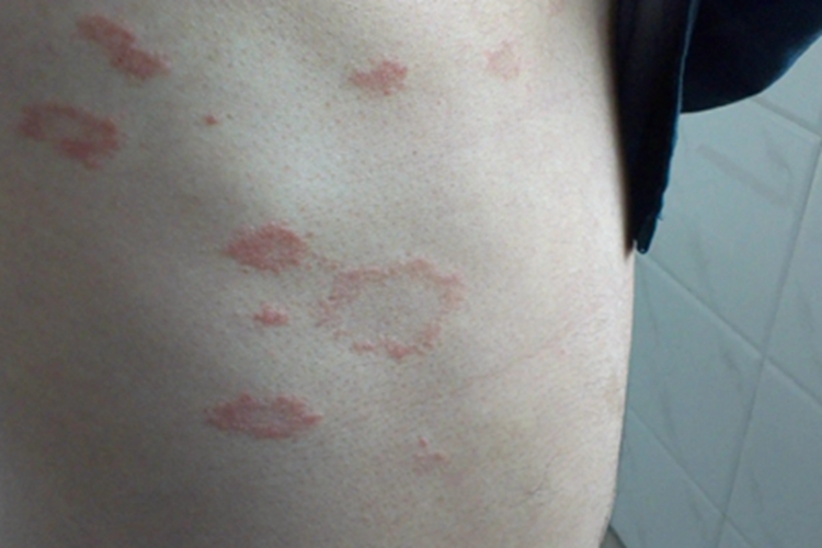 离心性环状红斑疙瘩图