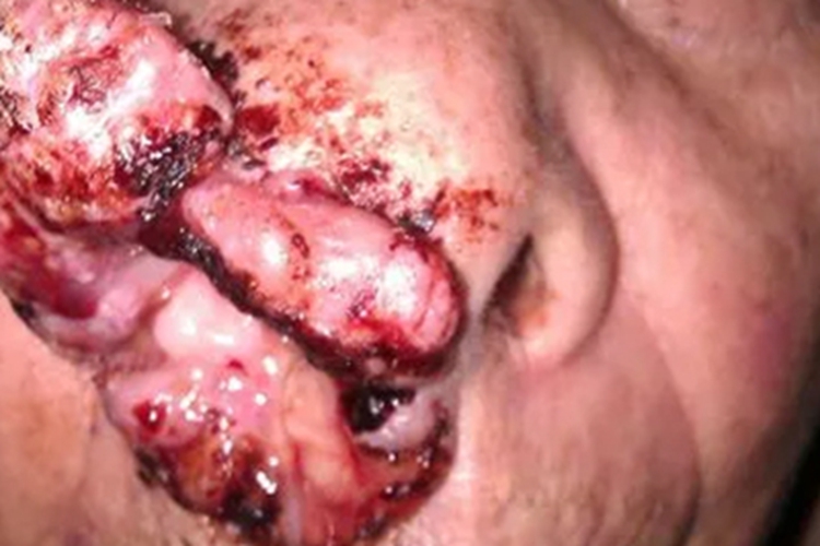 上颌窦癌鼻腔肿块图 上颌窦癌鼻腔肿块图