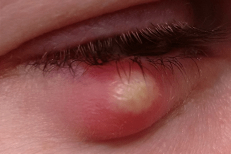 下眼皮睑板腺囊肿图