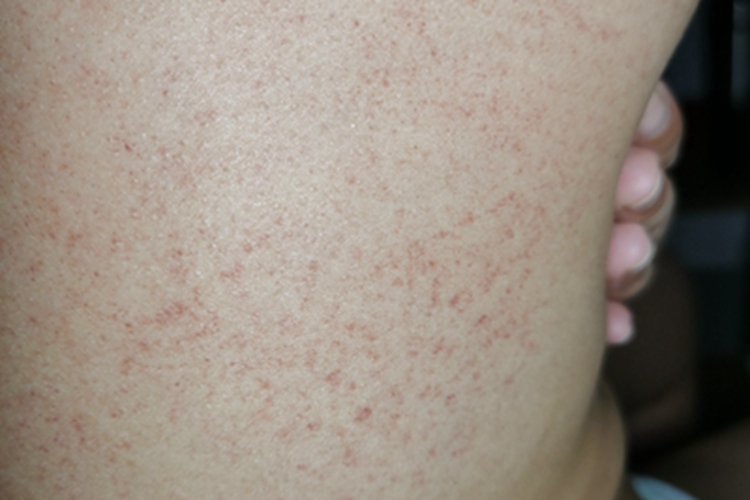 过敏性皮炎背部有大量红点图