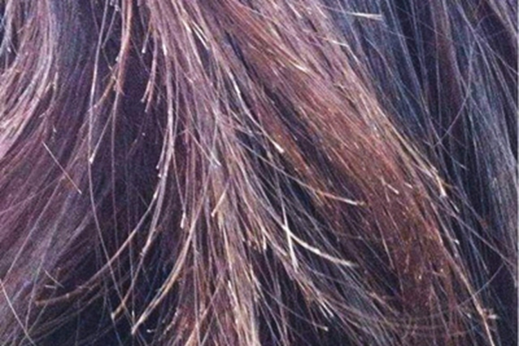 慢性维生素A过多症毛发分叉图 慢性维生素A过多症毛发分叉图