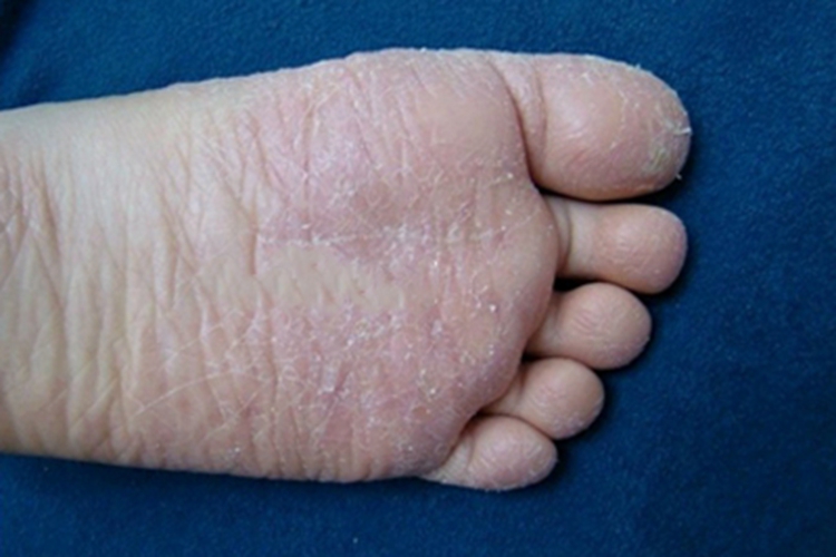 儿童期特应性皮炎苔藓化图 儿童期特应性皮炎苔藓化图