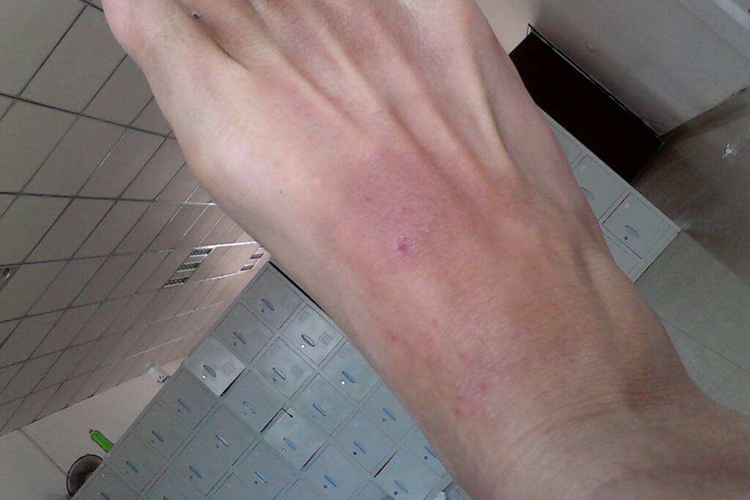 湿疹脚上长斑图