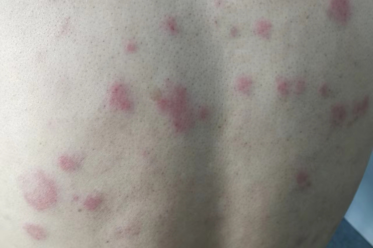 深在性红斑狼疮图 深在性红斑狼疮图