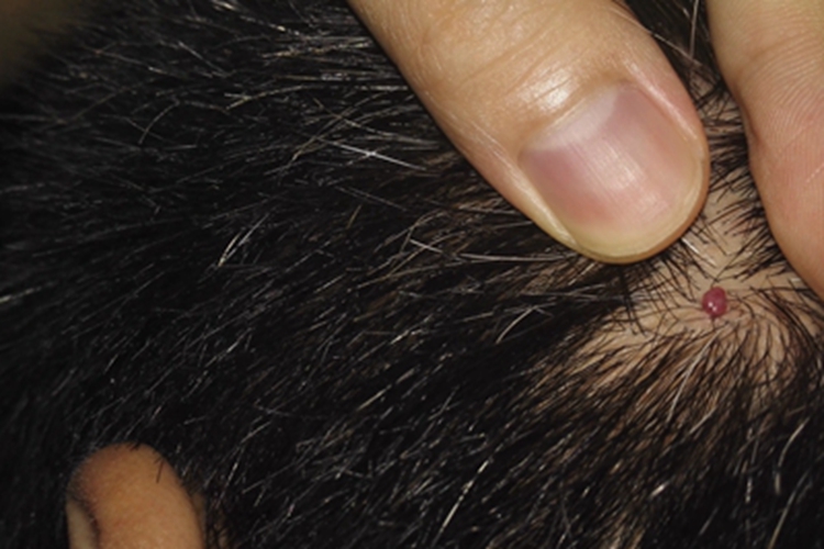 毛囊周围纤维瘤小红疙瘩图