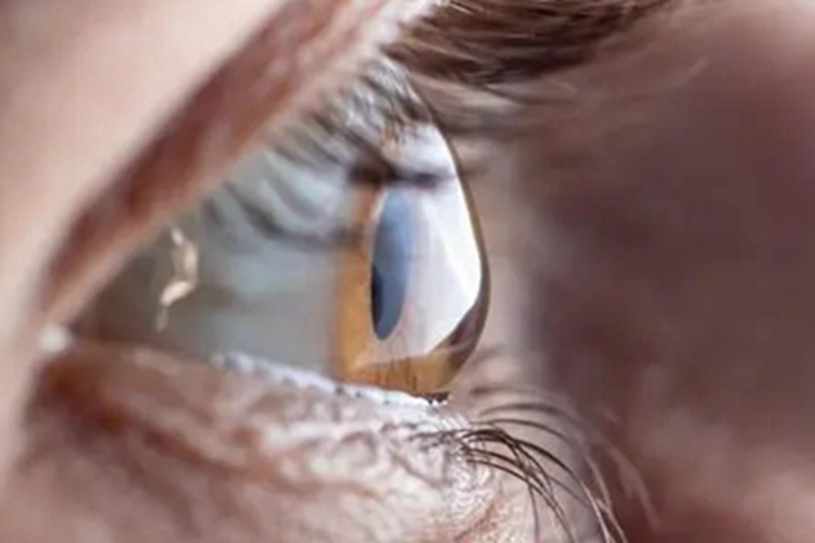 圆锥角膜眼球变形图