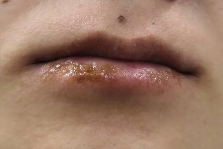 嘴巴过敏糜烂渗液图 嘴巴过敏糜烂渗液图