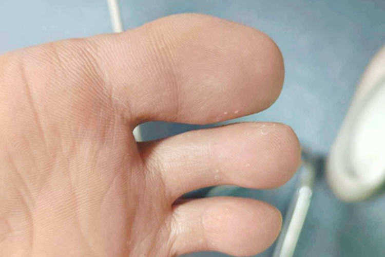 脚趾长水疱有白点图