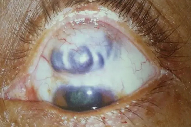 角膜葡萄肿图 角膜葡萄肿图