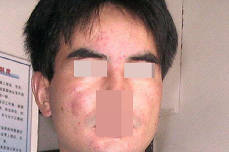 季节性接触性皮炎面部小红疙瘩图