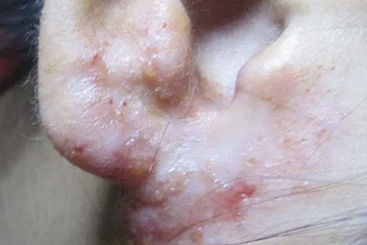 感染性湿疹渗液图
