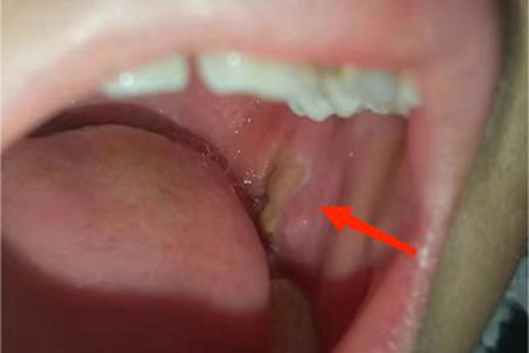 口腔溃疡口内颊部黄色溃疡图