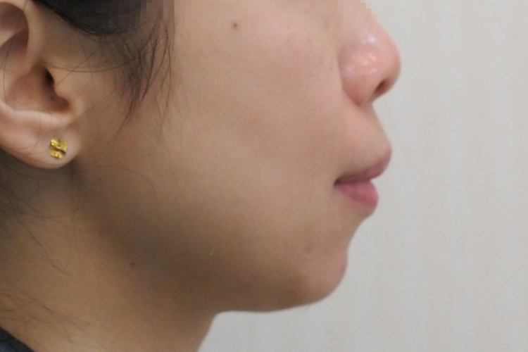 龅牙上颌前突畸形图 龅牙上颌前突畸形图