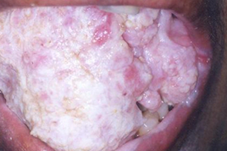 疣状癌口腔症状图 疣状癌口腔症状图