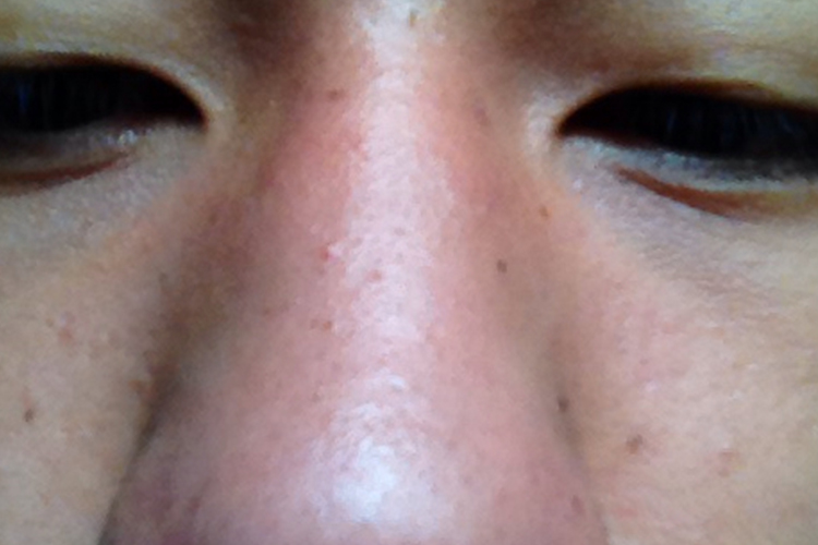 鼻窦炎鼻梁两侧肉鼓起图 鼻窦炎鼻梁两侧肉鼓起图