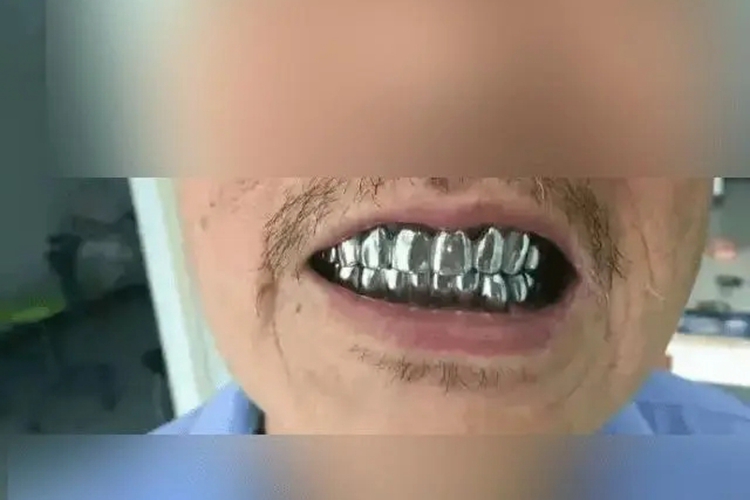 全口纯钛种植牙图