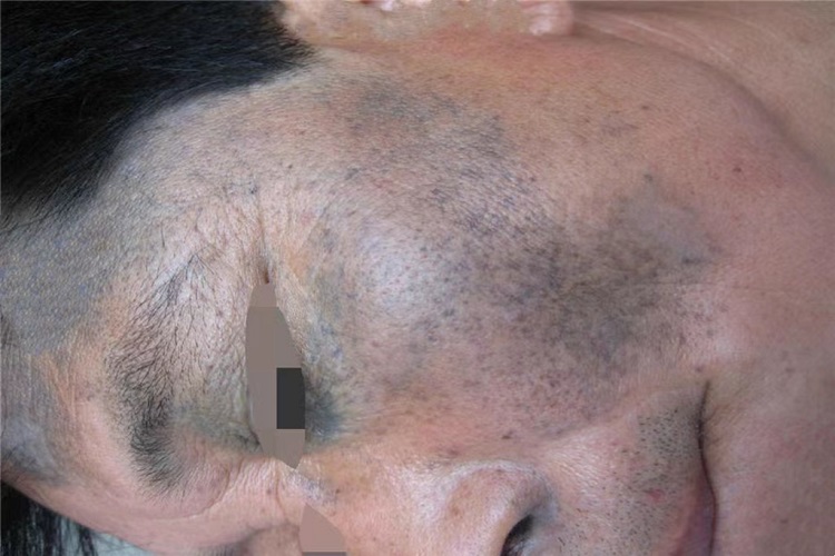 颧部褐青色痣颞部症状图 颧部褐青色痣颞部症状图