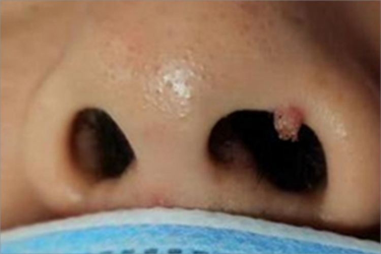 寻常疣鼻部小疙瘩图