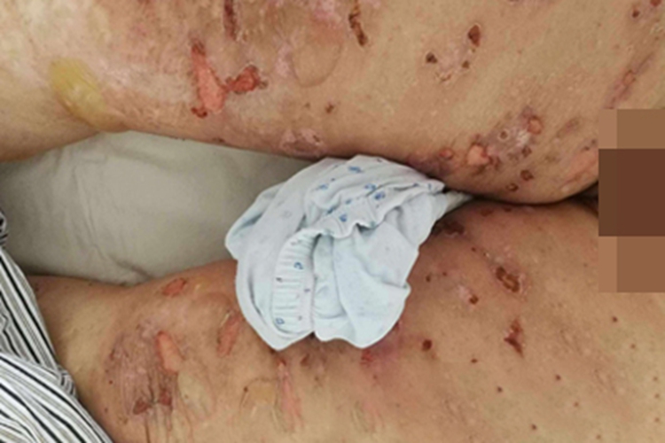 落叶型天疱疮糜烂图