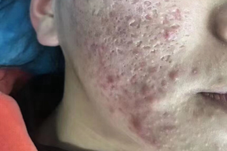 痤疮右侧脸颊有好多坑图