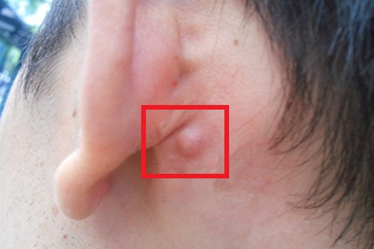 毛发囊肿耳后长疙瘩图