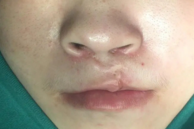 唇缺损嘴唇瘢痕图