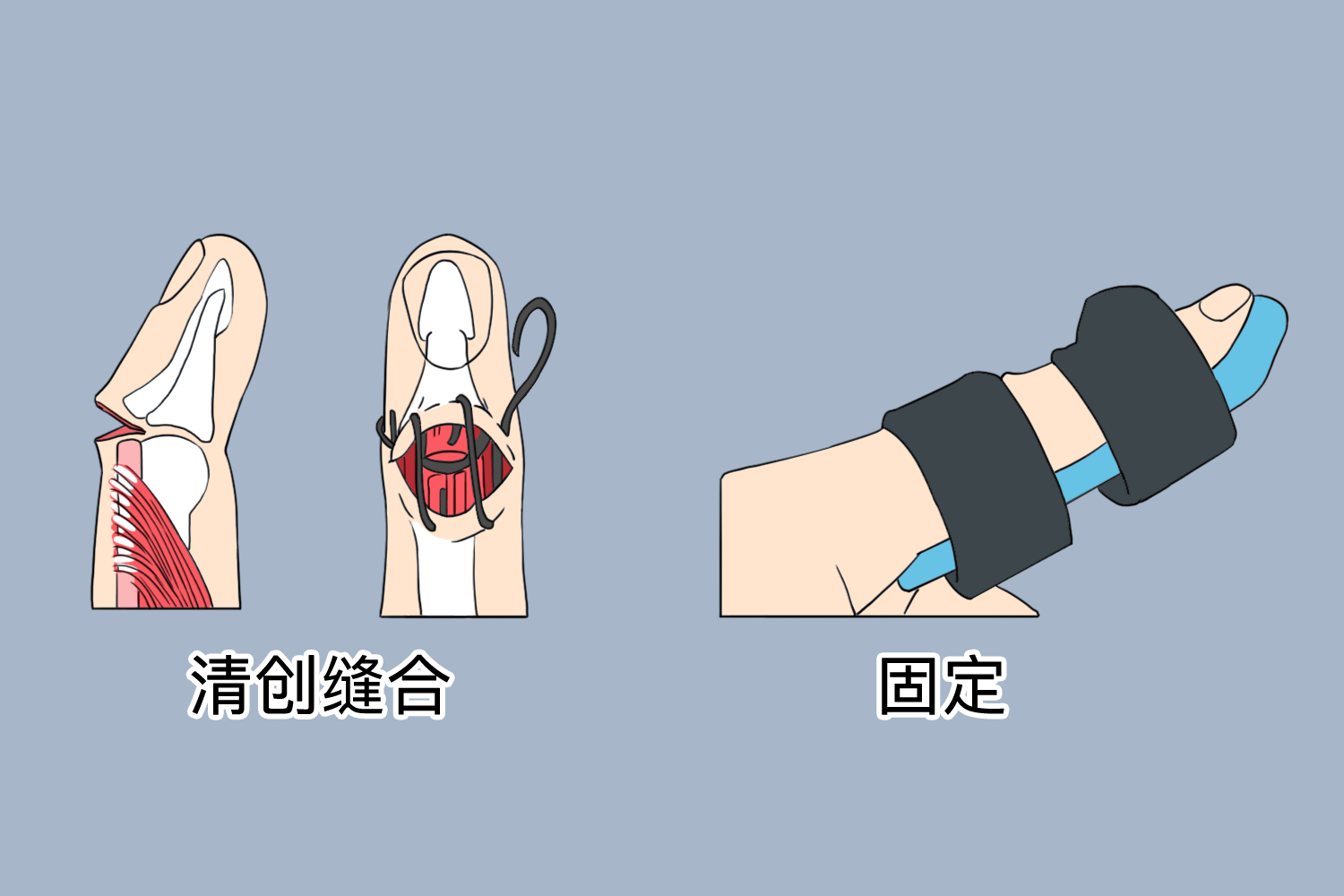 开放性锤状指手术步骤