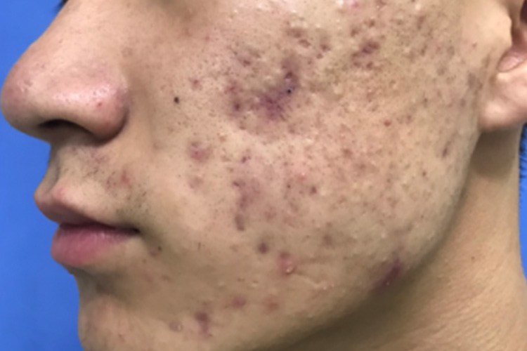 萎缩性痤疮图 萎缩性痤疮图