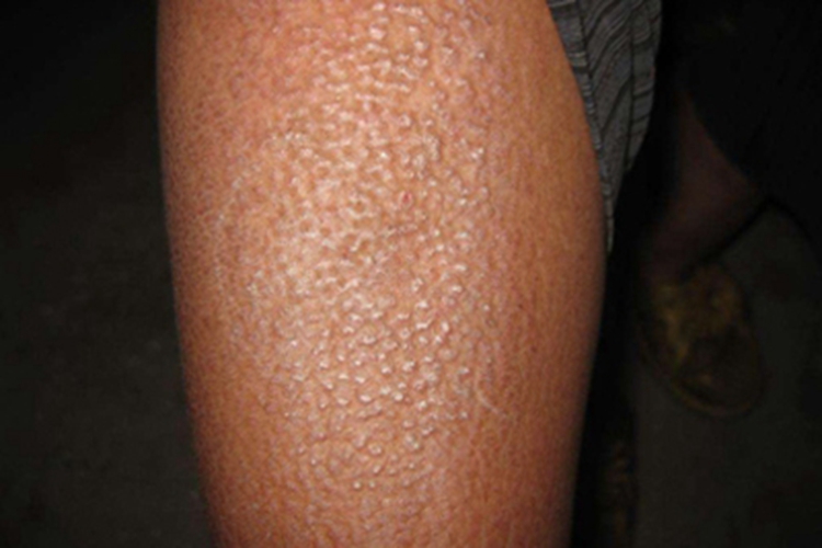 继发性皮肤淀粉样变小腿丘疹图 继发性皮肤淀粉样变小腿丘疹图