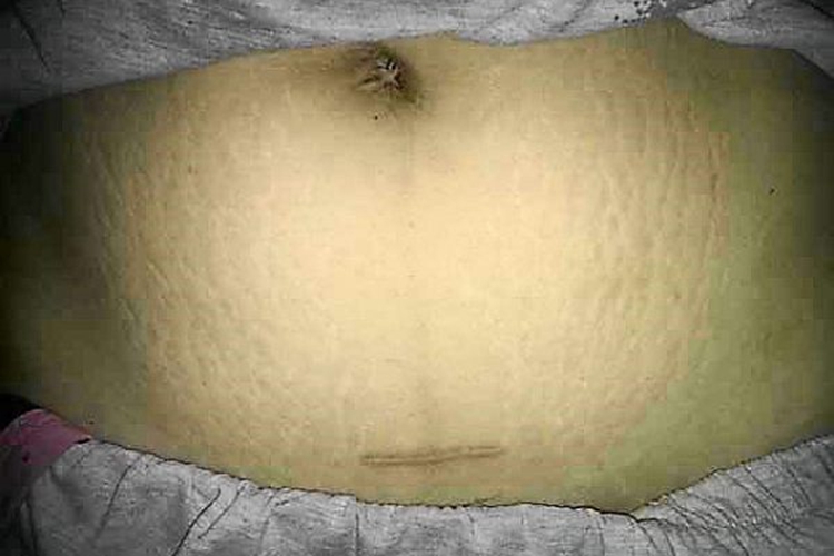 经腹输卵管结扎术疤痕图 经腹输卵管结扎术疤痕图