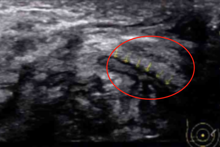 乳腺导管扩张Ⅲ型超声图