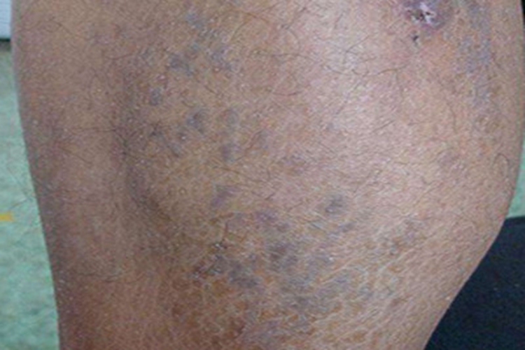 扁平苔藓小腿上有黑斑图