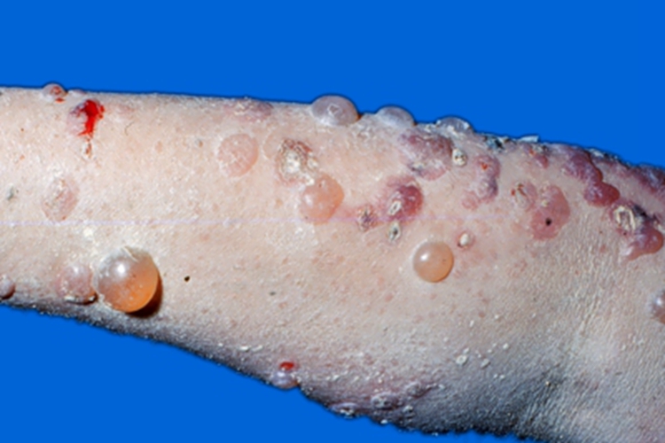 单纯型大疱性表皮松解症大疱图