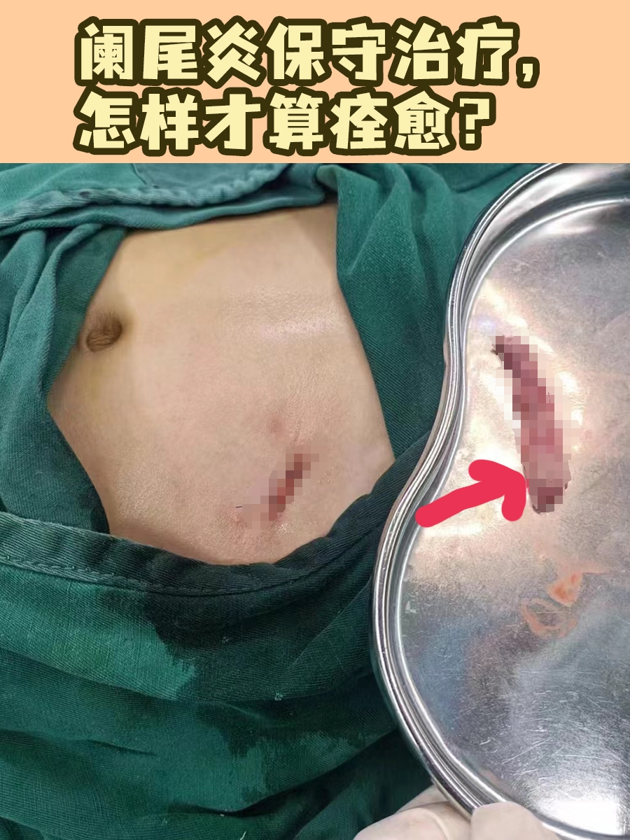 阑尾炎保守治疗,怎样才算痊愈?