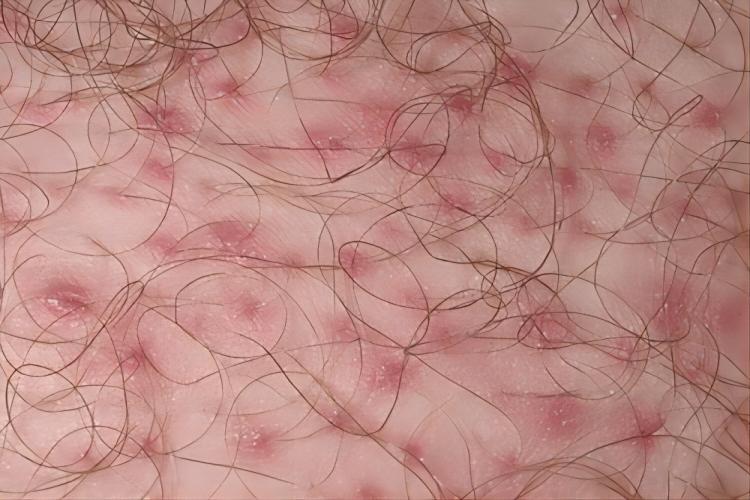 毛囊炎图 毛囊炎图