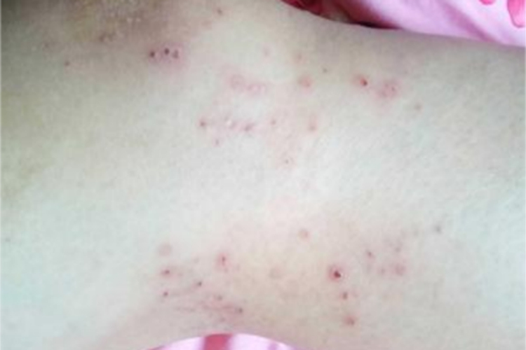 早发型妊娠痒疹腿丘疹图 早发型妊娠痒疹腿丘疹图