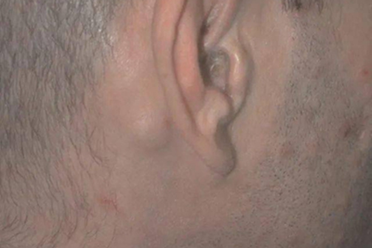男性梅毒耳后症状图