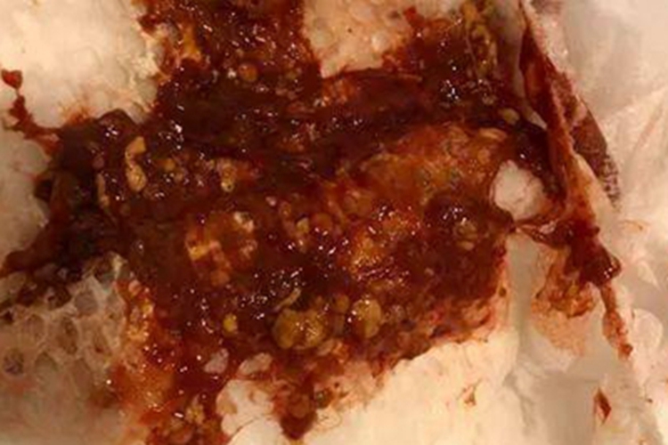 肠炭疽腹部血样便图